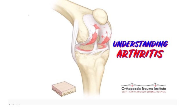 HEALTH: “UNDERSTANDING ARTHRITIS” – ORTHOPAEDIC TRAUMA INSTITUTE (VIDEO)