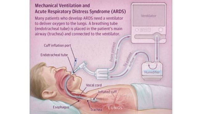 HEALTH: “MECHANICAL VENTILATION AND ACUTE RESPIRATORY DISTRESS SYNDROME” (INFOGRAPHIC)