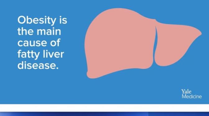 Medical Videos: ‘Fatty Liver Disease’ Affects One-Third Of U.S. Population