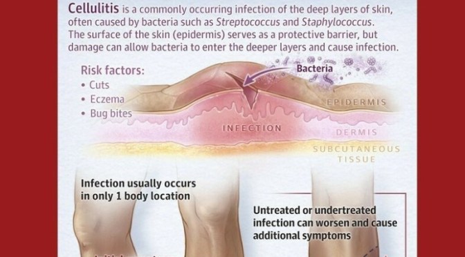 INFOGRAPHICS: ‘CELLULITIS’ – ITS CAUSE & TREATMENT