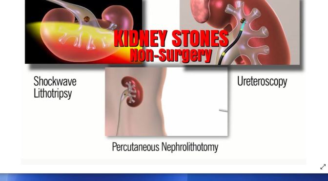 MEDICINE: ‘NON-SURGICAL TREATMENT OF KIDNEY STONES’ (CLEVELAND CLINIC)