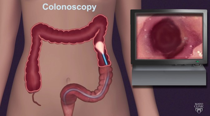 DR. C’S JOURNAL: BENEFITS OF COLONOSCOPIES OVER 50
