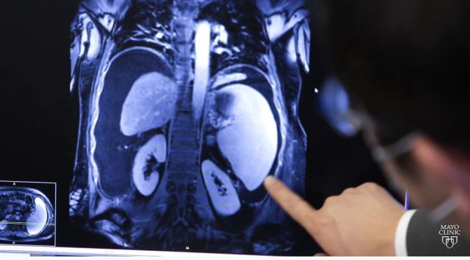 MEDICINE: WHEN COLON CANCER SPREADS TO THE LIVER (MAYO CLINIC VIDEO)