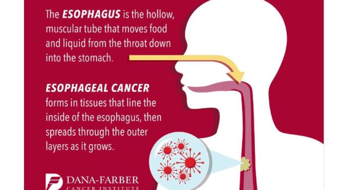 ESOPHAGEAL CANCER: SYMPTOMS & DIAGNOSIS