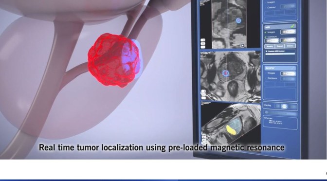 Cancer: High-Intensity Focused Ultrasound