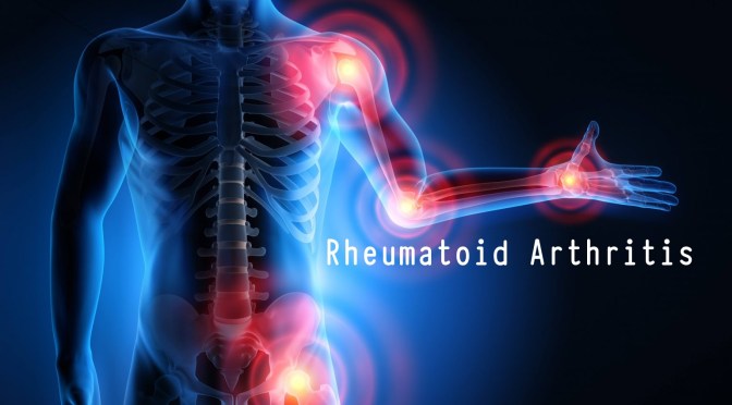 MEDICINE: ‘AI’ CAN PREDICT RHEUMATOID ARTHRITIS