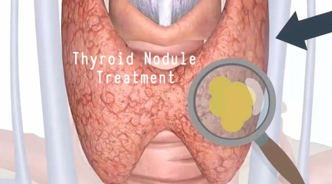 Endocrinology: Thyroid Nodule Treatment (Video)