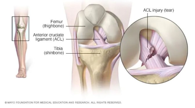 Mayo Clinic: ACL Tears – When Surgery Is Needed