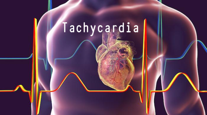 Tachycardia: Types, Causes & Symptoms (Mayo Clinic)