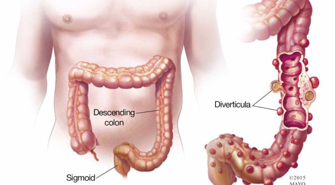 Diverticulitis: Diagnosis And Testing (Mayo Clinic)