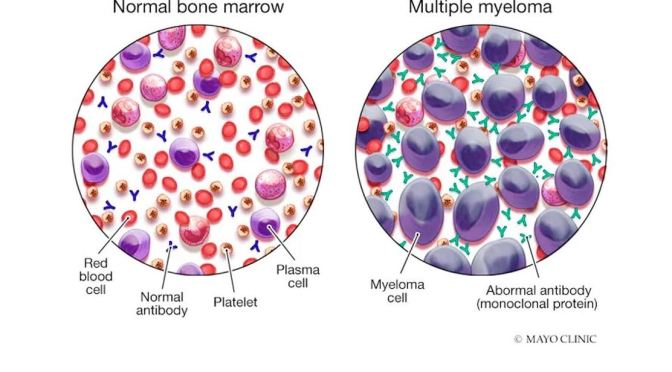 DR. C’S JOURNAL: WHAT IS MULTIPLE MYELOMA?