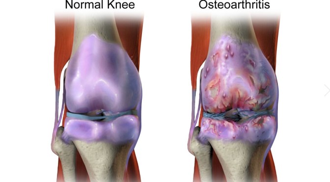 OSTEOARTHRITIS: SYMPTOMS & TREATMENT OPTIONS (UVA)