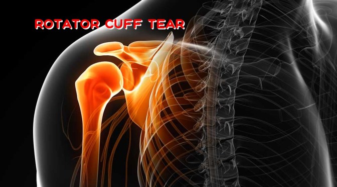 Medicine: Mayo Clinic Research Speeds Rotator Cuff Tear Healing Period