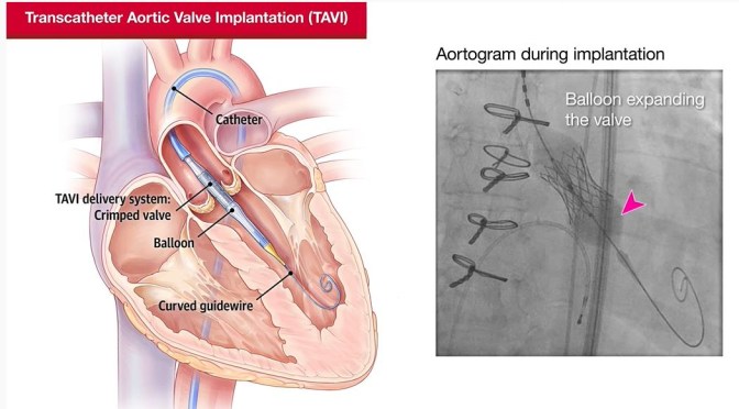 MEDICINE: TRANSCATHETER TREATMENTS FOR VALVULAR HEART DISEASE (JAMA VIDEO)