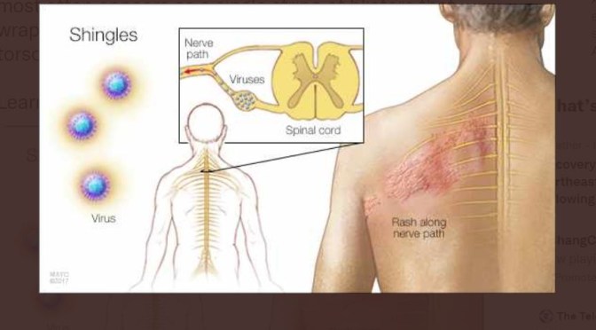 Viral Infections: Shingles