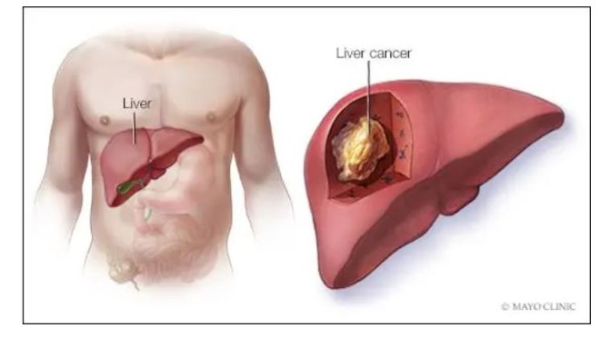 Podcast: Treating And Preventing Liver Cancer