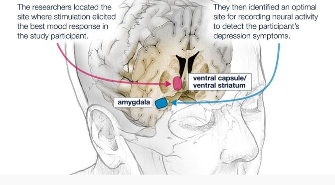 TREATING DEPRESSION: DEEP BRAIN STIMULATION (UCSF)