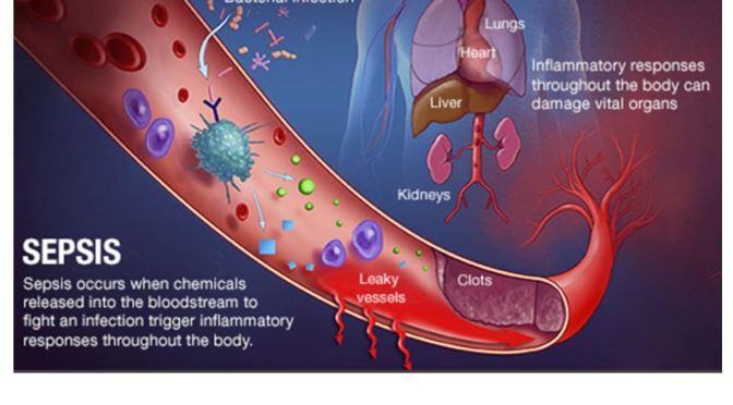 Covid-19 & Flu Can Spark Sepsis, Endangering Heart