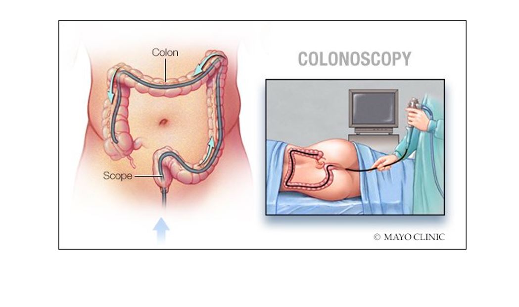 Procedures Preparing For A Colonoscopy (Mayo) Doctors Without