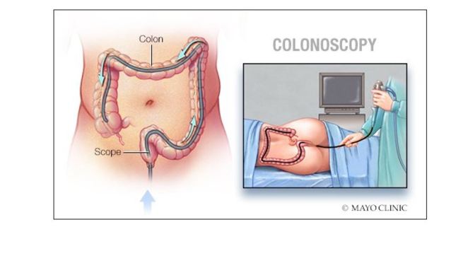 Procedures: Preparing For A Colonoscopy (Mayo)
