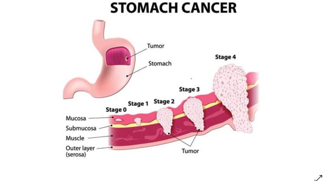 Prevention: Risk Factors For Stomach Cancer