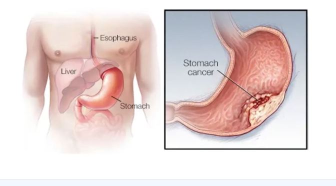 Oncology: Symptoms & Signs Of Stomach Cancer