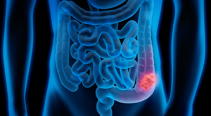 Colorectal Cancer: Some Myths & Facts Explained