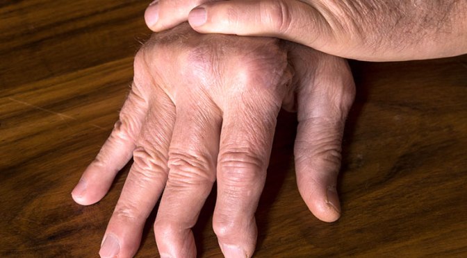 Inflammation: ‘Psoriatic Arthritis Fatigue’ Care