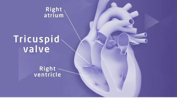Heart Health: Tricuspid Regurgitation Treatment