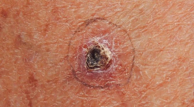 Basal Cell Carcinoma: Diagnosis And Treatment