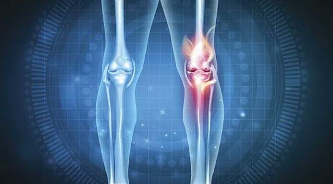 Osteoarthritis: Increased Walking Lowers Knee Pain