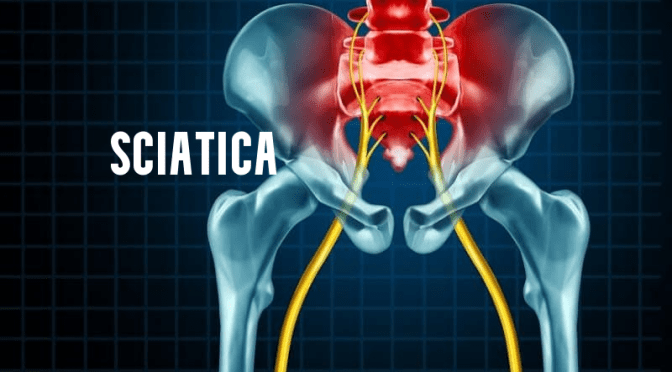 Back Pain: The Symptoms And Causes Of Sciatica