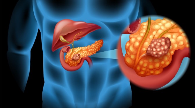 Diagnosis: Warning Signs Of Pancreatic Cancer