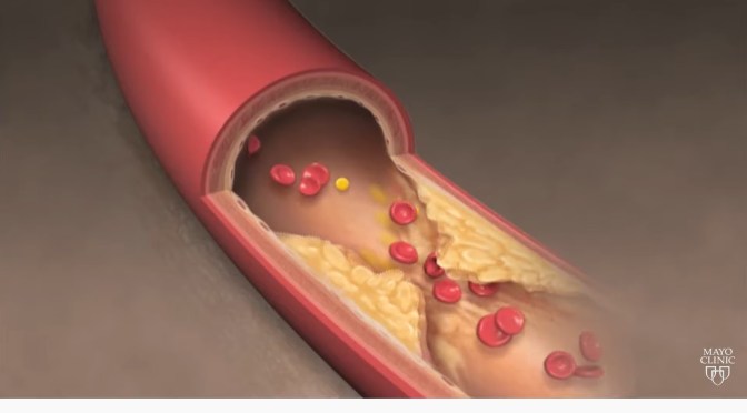 Heart Health: What To Know About Cholesterol