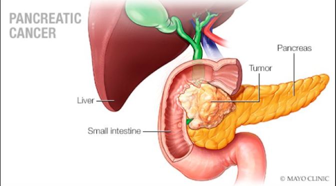 Diagnosis: The Early Signs Of Pancreatic Cancer