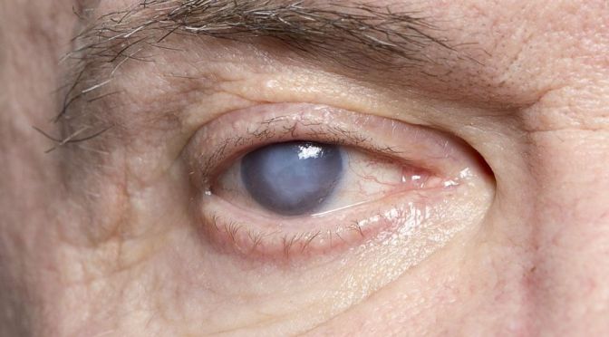 Eye Health: Cataracts
