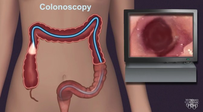 Colorectal Cancer: ‘Miss Rate’ Lowered 50% Using AI