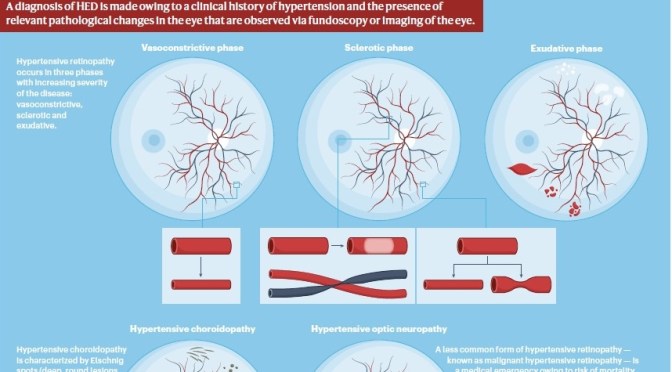 Retinal Disorders: What Is Hypertensive Eye Disease?
