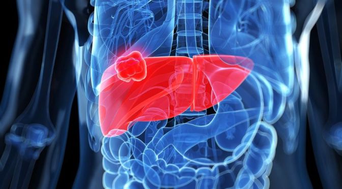 Diagnosis: Mayo Clinic Explains Liver Cancer