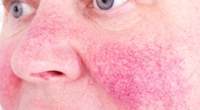 Skin Conditions: What Are The Causes Of Rosacea?