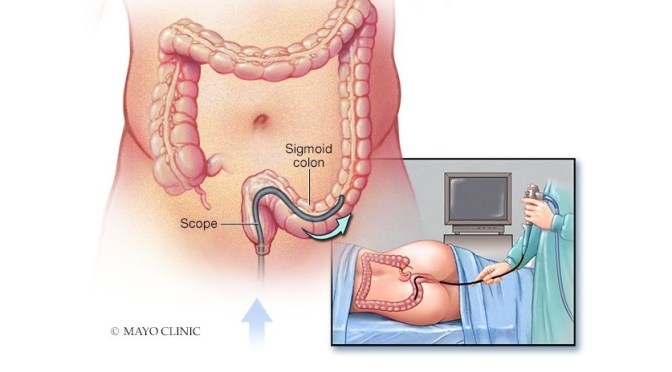 Procedures: The Benefits Of A Sigmoidoscopy Exam