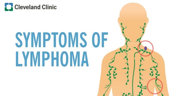 Cancer Diagnosis: The Symptoms Of Lymphoma