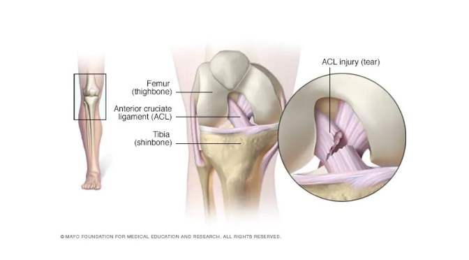Knee Injuries: Options For ACL Surgery (Mayo Clinic)