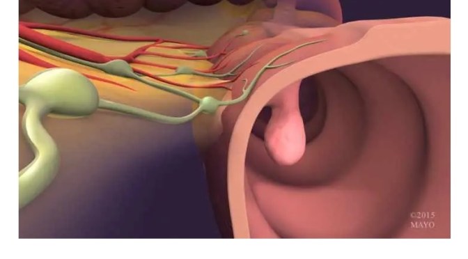 Precancerous Polyps: AI Reduces Screening Misses