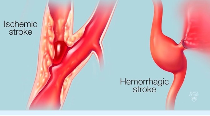 Neurovascular Disease: Stroke Awareness & Care