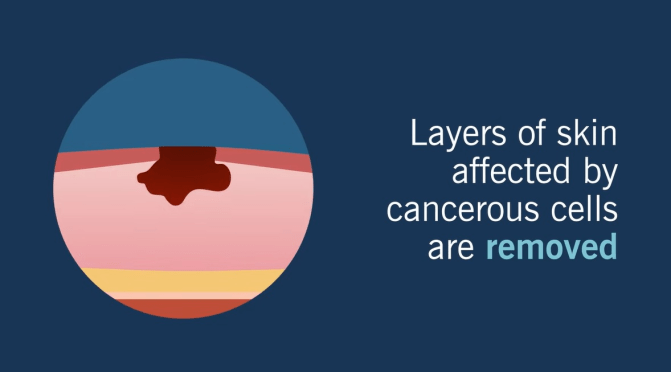 Skin Cancer Removal: The Benefits Of Mohs Surgery