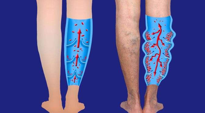 Varicose Veins: Symptoms And Treatment (Harvard)