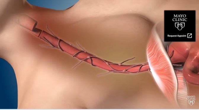 Esophageal Cancer: Early Treatment Is Critical