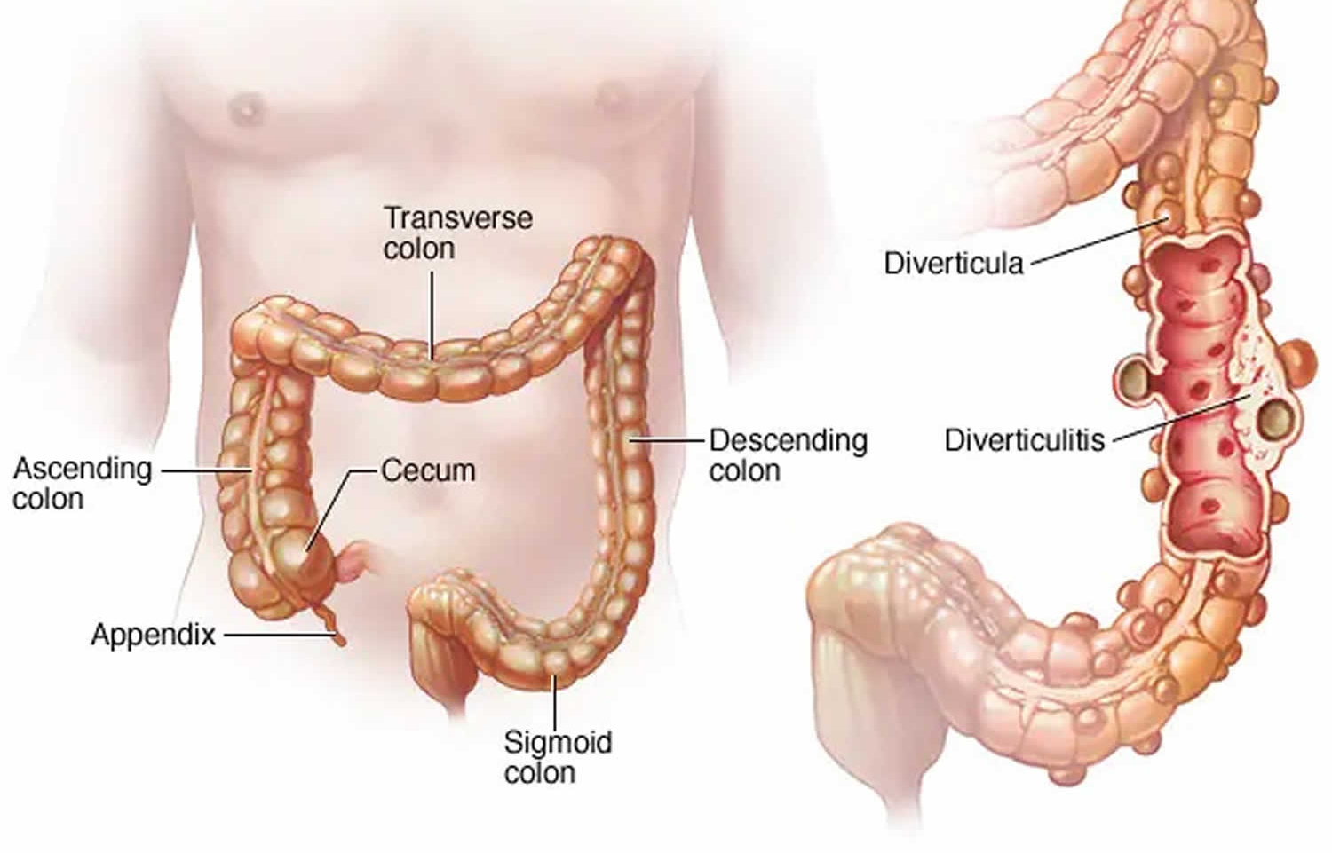 Distal Colonic Infographic: Colonic Diverticular Disease | Doctors Without Waiting Rooms