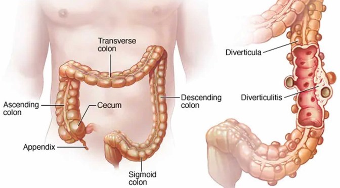 Infographic: Colonic Diverticular Disease